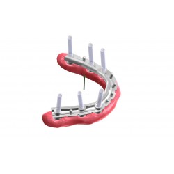 Modul exocad Bar exocad