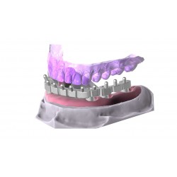 Modul exocad Bar exocad