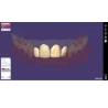 Modul exocad Provisional