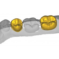 Modul exocad Provisional