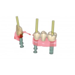 MODUL EXOCAD IMPLANT