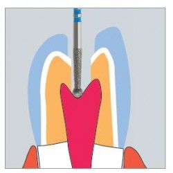 Freze Diamant ZirTec Cap Lung Rotunjit cu Extensie Conica FG K802L - 5 buc. 