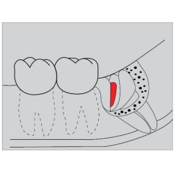 Freze Surgery Diamond FGXXL  G254  317 014