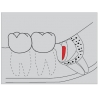 Freze Surgery Diamond FGXXL  G254  317 014
