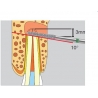 Freze Surgery Diamond FGXXL  D254  317 016