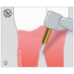 Freze Soft Tissue Trimmer  STT2 49 314 016