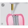 Freze Soft Tissue Trimmer  STT2 50 314 016