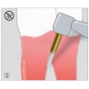 Freze Soft Tissue Trimmer  STT2 50 314 016