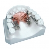 Dispozitiv distalizare dreapta Fast Back 9mm Leone