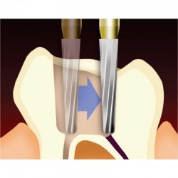 Freze Endo Safe End SSWhite