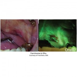 Scanner Depistare Cancer Bucal OralID Kit Forward-Science