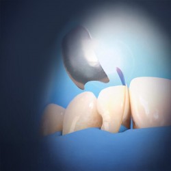 Matrici anterioare Unica Proximal 0.030mm standard 50 bucati Polydentia