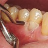 Matrici cervicale incisivi pentru instrumentul manual LM-MultiHolder LM-Dental
